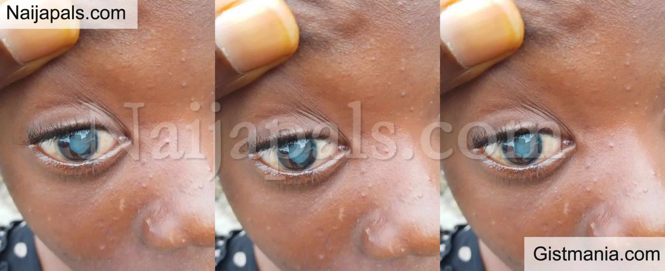 13Yr Old Girl Disfigured By Guardian In Imo State Set To Undergo Surgery