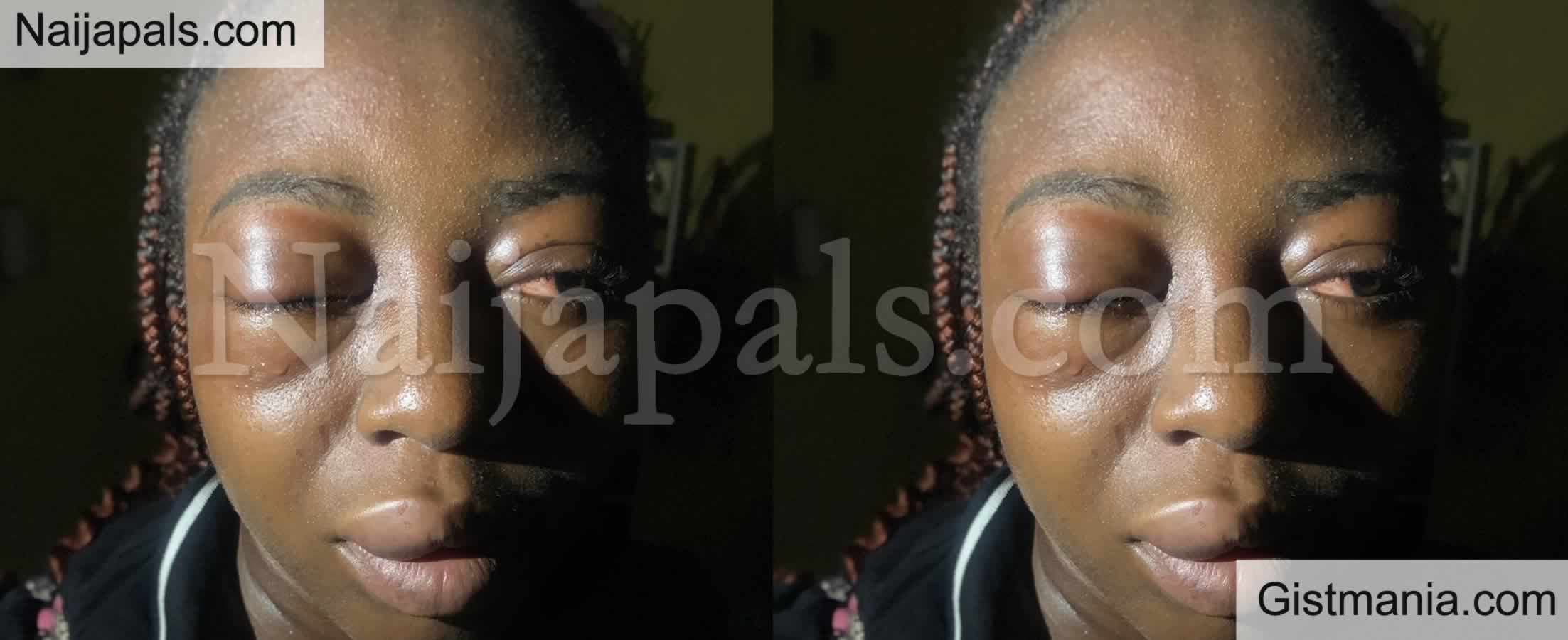 Lady Fabiyi Abosede Battered And Robbed By Four Men In Lagos, Shares Photo