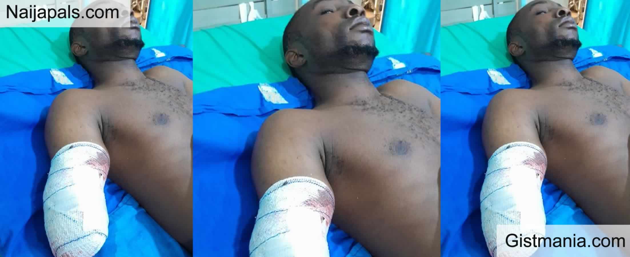 Taraba Student, Iorhee Saanmoyol Paul Who Lost Both Hands to Electrocution Loses an Eye, Seeks Help