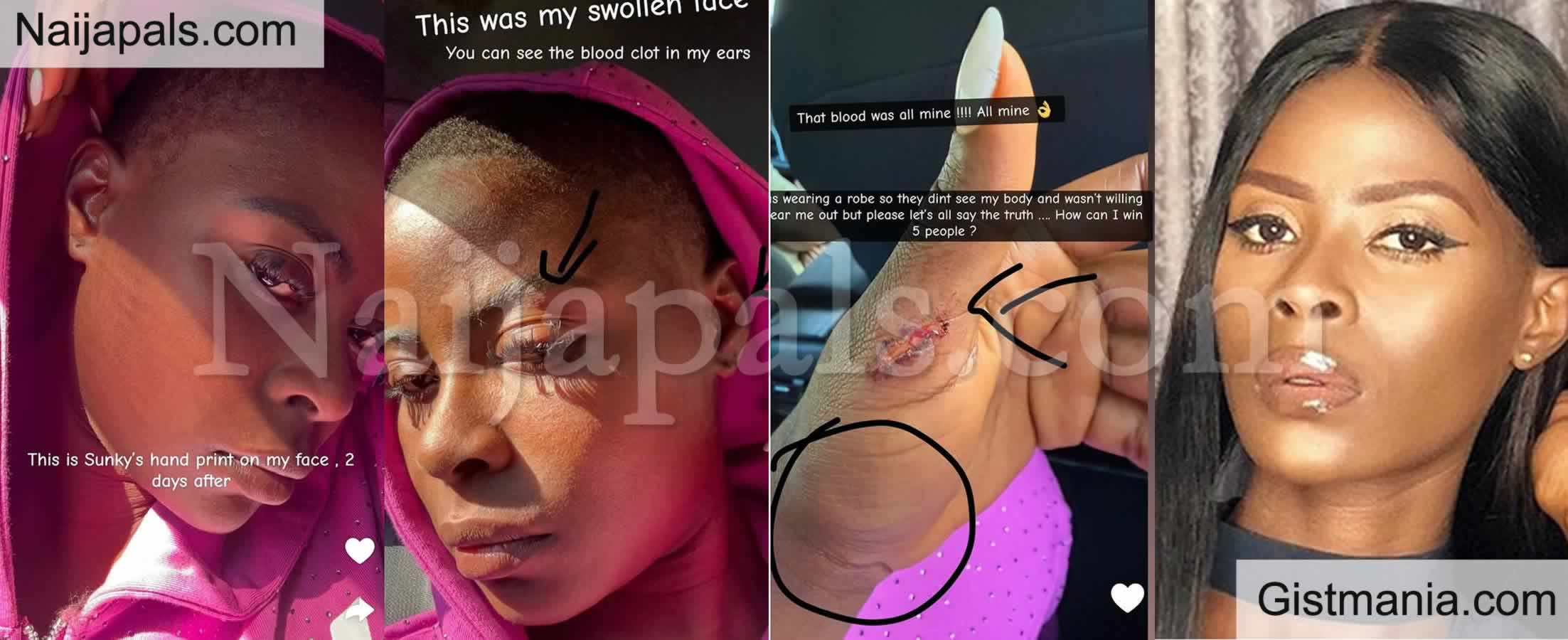 BBNaija Khloe Shows Swollen Face, Bruised Body as She Recounts Attack at An Event in Italy