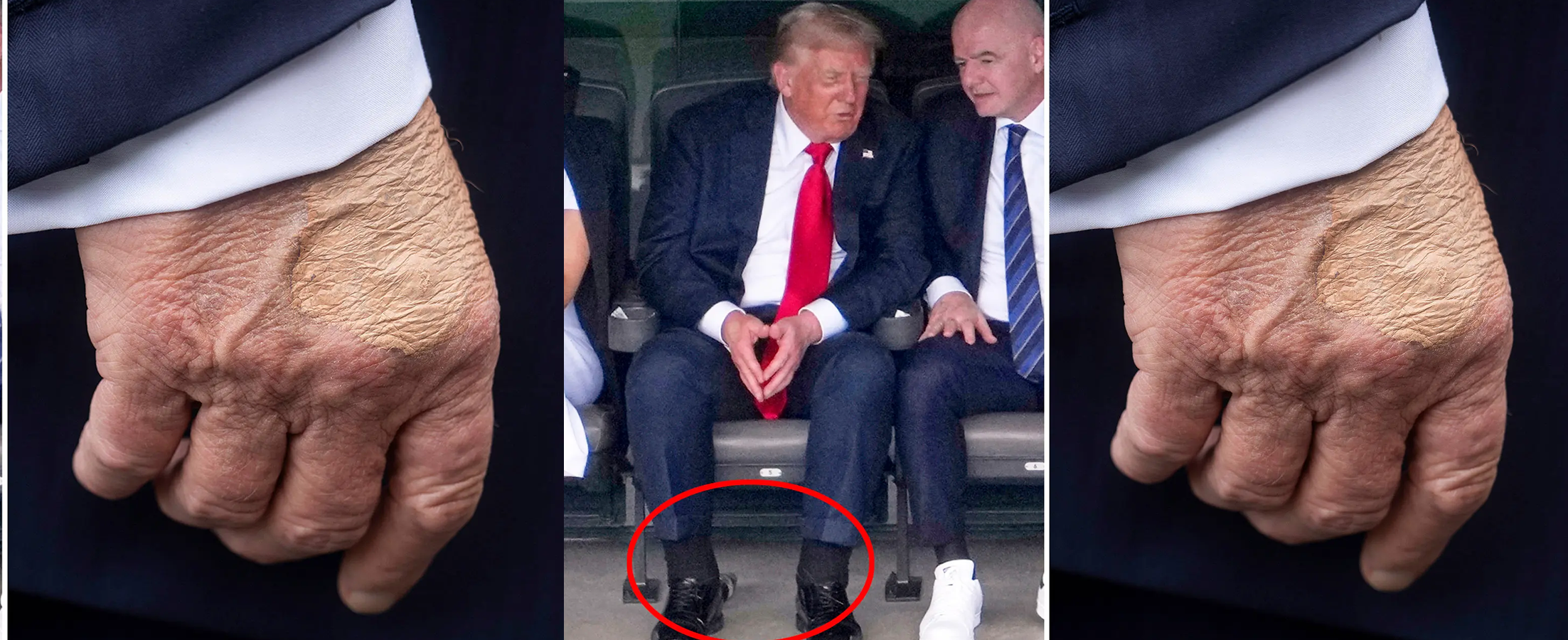 President Donald Trump Of US Diagnosed With Chronic Venous Insufficiency Following Leg Swelling